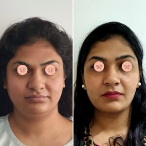 rhinoplasty before after pictures