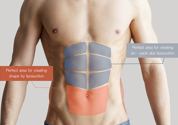 Six Pack Abs Surgery in Gurgaon