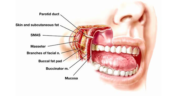 Buccal Pad Fat Removal Surgery in Gurgaon