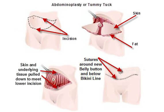 Tummy Tuck Surgery in Gurgaon