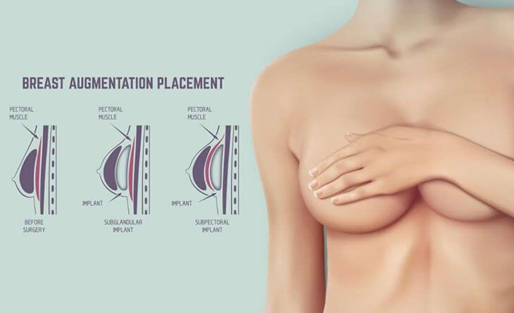 Breast Augmentation in Gurgaon