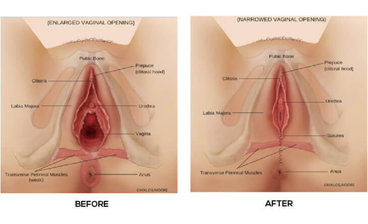 Vaginal Tightening Surgery in gurgaon
