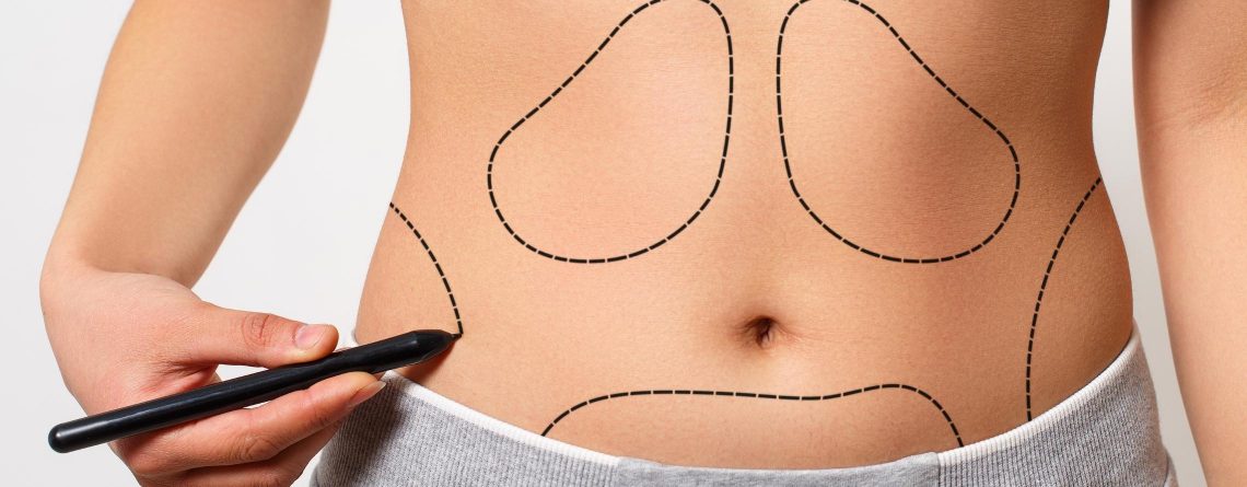 Body Contouring surgery in gurgaon