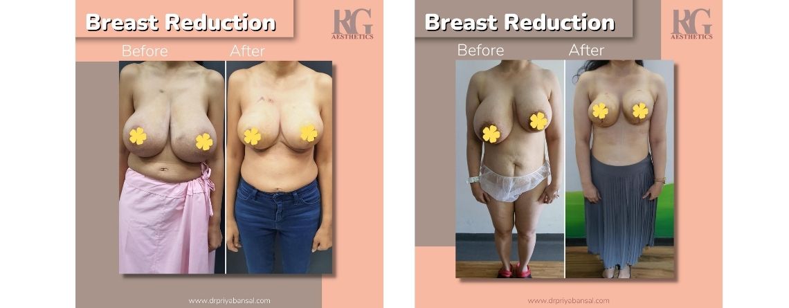 breast reduction surgery before after