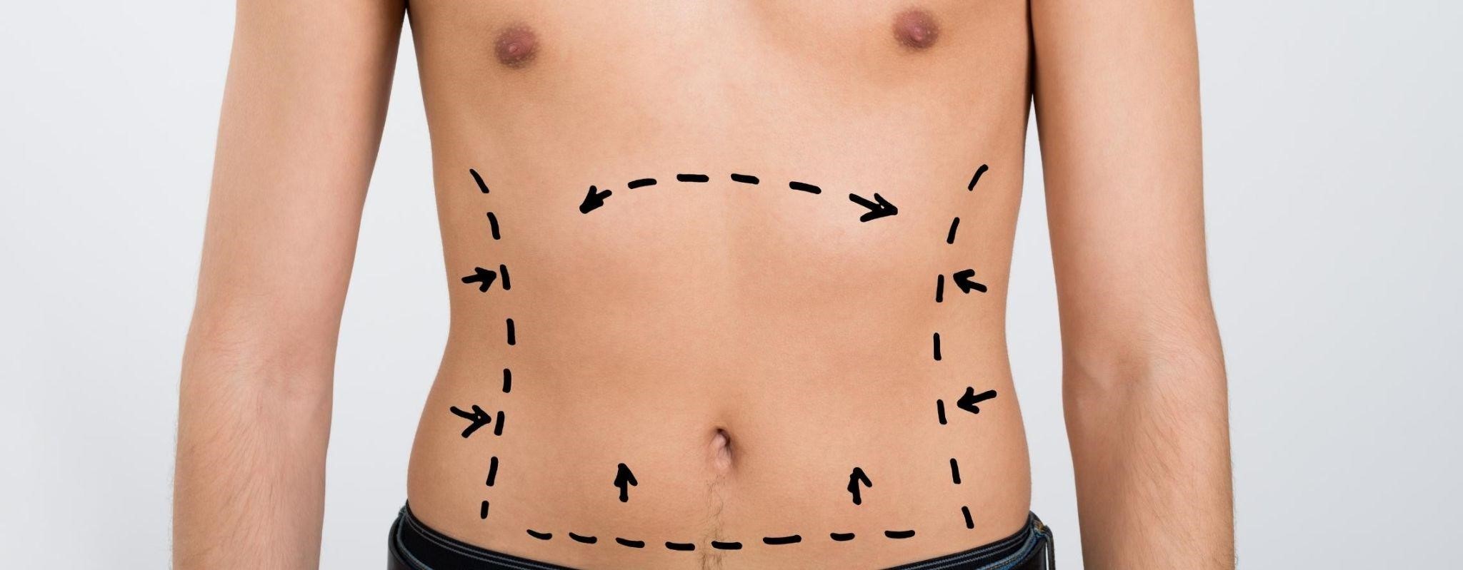 liposuction surgery in India