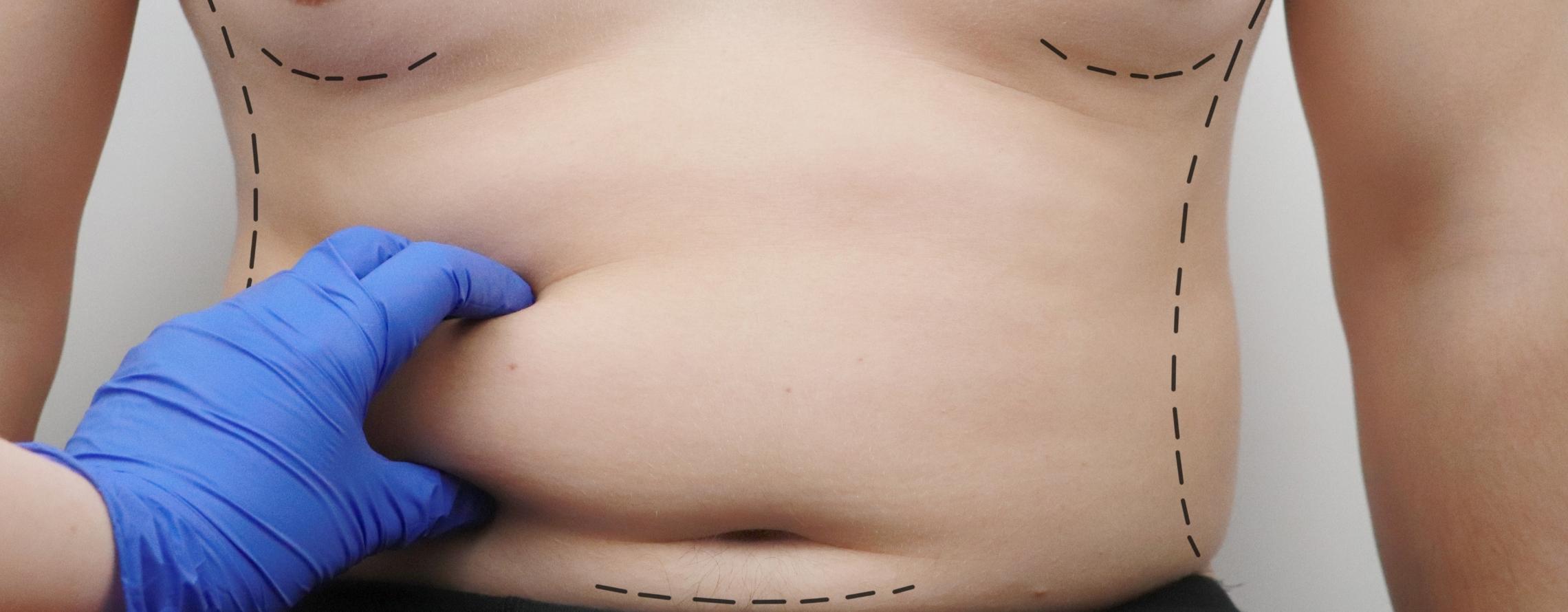 liposuction for Men