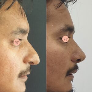 rhinoplasty before after picture