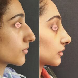 rhinoplasty surgery before after picture