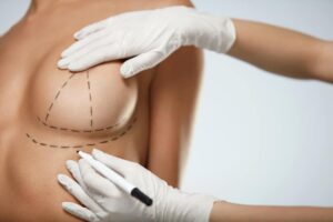 breast lift surgery recovery in Delhi