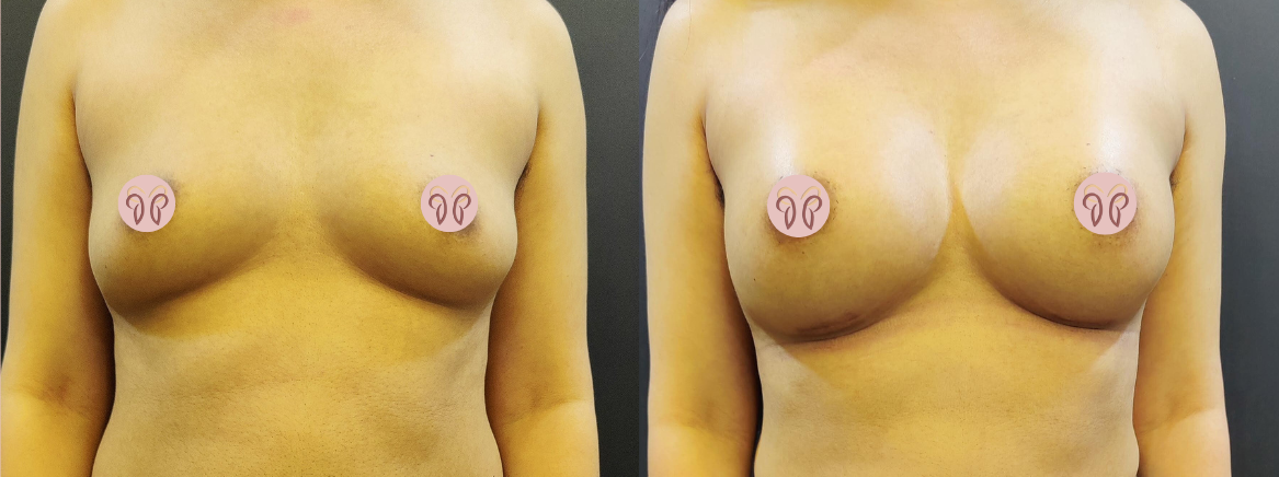 breast augmentation results