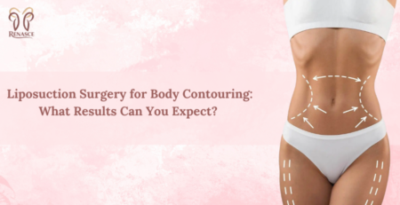 liposuction for body